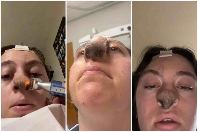 Vídeo: mulher fica com nariz peludo depois de cirurgia por ter sido mordida por pitbull
