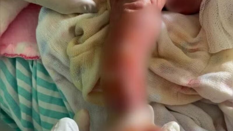 Recém-nascida no Acre que teve os pezinhos queimados no primeiro banho está em estado grave no “João 23”