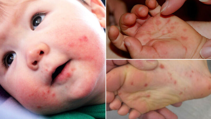 ATENÇÃO: Secretaria de Saúde de Itaúna registra surto da doença viral Mão-Pé-Boca