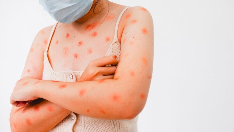 Sobe para cinco o número de casos de contaminação de Mpox em Minas em 2026