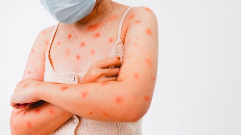 Sobe para cinco o número de casos de contaminação de Mpox em Minas em 2026