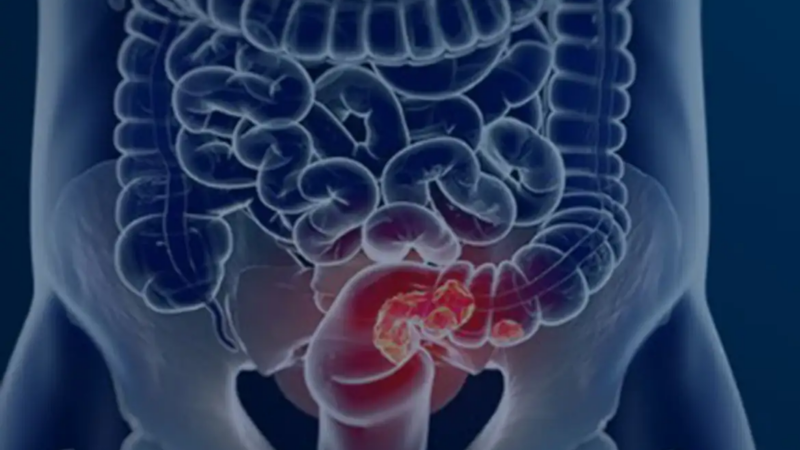 SUS adota novo exame não invasivo para rastrear câncer de intestino na população
