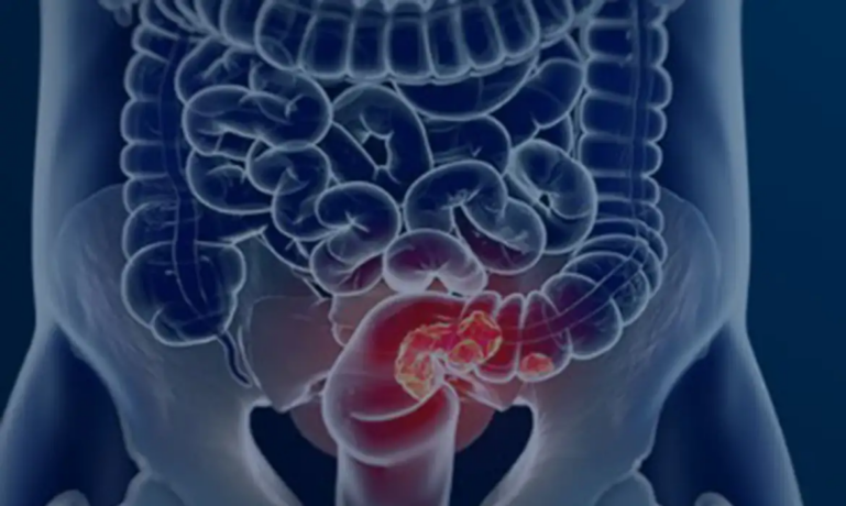 SUS adota novo exame não invasivo para rastrear câncer de intestino na população